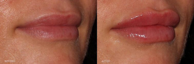 This is a side by side view photos of a woman's lower face before and after Lip Filler procedure. Before photo shows unevenly shaped lips with her upper lip being thinner than the lower lip while after photo shows more pouter lips with her both upper and lower lip with the same volume. | Albany, Latham, Saratoga NY, MedSpa