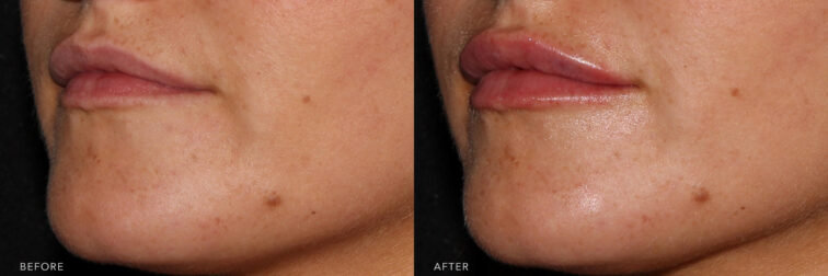 This is a side by side view photos of a woman's lower face before and after Lip Filler procedure. Before photo shows a lips breaks down and tired muscles, leaving her lips to look thinner while after photo shows a plump and fuller lips.| Albany, Latham, Saratoga NY, MedSpa