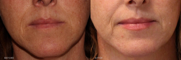 This is a side by side view photos of a woman's lower face before and after 3 IPLS Treatments procedure. Before photo shows her sun damage spots with her vissible redness on her face while after photo shows her improved color and texture of her skin. | Albany, Latham, Saratoga NY, MedSpa
