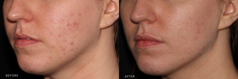 Side-by-side profile view of a person's cheek demonstrating acne improvement and non-surgical double chin removal, labeled 