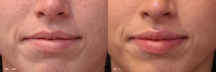 A photos of a woman's lower face before and after Lip Filler procedure. Before photo shows a longer and flatter distance between the corners of her mouth while after photo shows a restored lip size and having more volume of her lips.| Albany, Latham, Saratoga NY, MedSpa