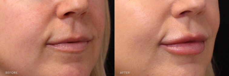A photos of a woman's lower face before and after Lip Filler procedure. Before photo shows a declined plumpness of her lips while after photo shows a sharpened lip contour and well balanced lip asymmetry.| Albany, Latham, Saratoga NY, MedSpa