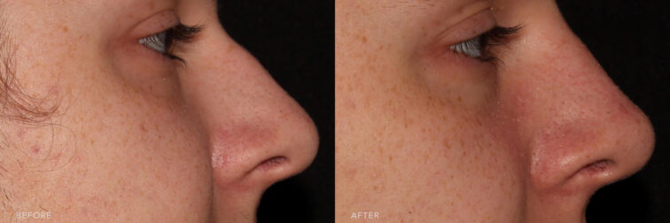 This is a side by side view photos of a man's face before and after Nonsurgical Rhinoplasty procedure. Before photo shows a hump in his nasal structure while after phooto shows more enhanced and straightened nose. | Albany, Latham, Saratoga NY, MedSpa