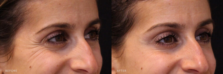 This is a side by side view photos of a woman's face before and after Botox proccedure. Before photo shows her under eye wrinkles while after photo shows a relaxed facial muscles that lessen her wrinkles around her eyes. | Albany, Latham, Saratoga NY, MedSpa