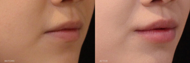 A photos of a woman's lower face before and after Lip Filler procedure. Before photo shows her thin shaped and small lips. | Albany, Latham, Saratoga NY, MedSpa while after photo shows her restored and more volume her lips. | Albany, Latham, Saratoga NY, MedSpa