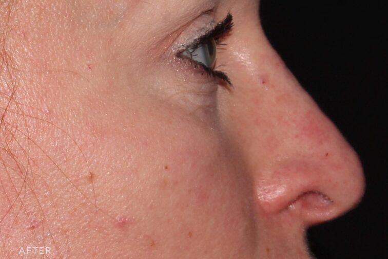 This is a photo of a woman's face with her straightened nose bridge. | Albany, Latham, Saratoga NY, MedSpa