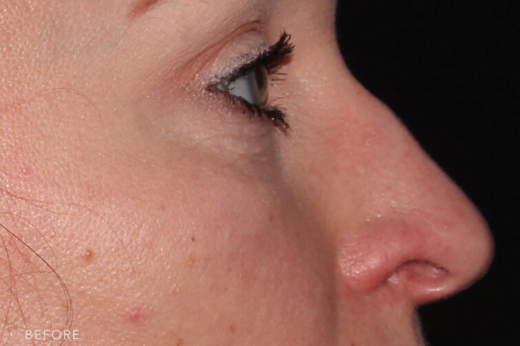 This is a photo of a woman's face with her dorsal hump in her nose. | Albany, Latham, Saratoga NY, MedSpa