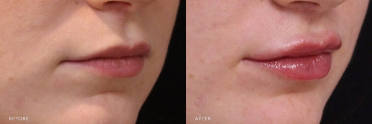 This is a side by side view photos of a woman's lower face before and after Lip Filler procedure. Before photo shows her lips that lost its volume and natural sharp margins while after photo shows more volume with her contoured lip edges that makes it more beautiful and sharper. | Albany, Latham, Saratoga NY, MedSpa
