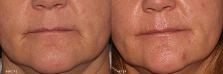 A photos of a woman's lower face before and after Mouth Line Filler procedure. Before photo shows wrinkles along the sides of her mouth while after photo shows reduced appearance of wrinkles around her mouth that made it more smoother. | Albany, Latham, Saratoga NY, MedSpa