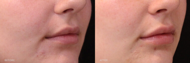 This is a side by side view photo of a woman's lower face before and after Lip Filler procedure. Before photo shows a thin lips that increased the distance between the corners of her mouth while after photo shows a corrected lip size which makes it look more pouty.| Albany, Latham, Saratoga NY, MedSpa
