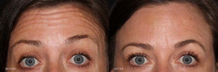 A photos of a woman's upper before and after Botox procedure. Before photo shows wrinkles in the forehead and around the eyes while after photo shows a relaxed facial muscles that helped minimize the appearance of lines and wrinkles caused by facial expressions.| Albany, Latham, Saratoga NY, MedSpa