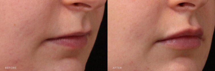 This is a side by side view photos of a woman's lower face before and after Lip Filler procedure. Before photo shows a mouth that started to sink inward while after photo shows a fuller and shinier appearance with her pouty lips.| Albany, Latham, Saratoga NY, MedSpa