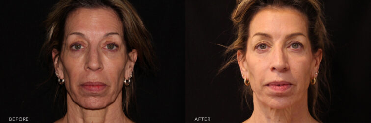 A photos of a woman's face before and after Botox procedure. Before photo shows an evident fine lines and wrinkles in her face while after photo shows an improved appearance of puffiness, wrinkles and dark shadows which makes her look younger. | Albany, Latham, Saratoga NY, MedSpa