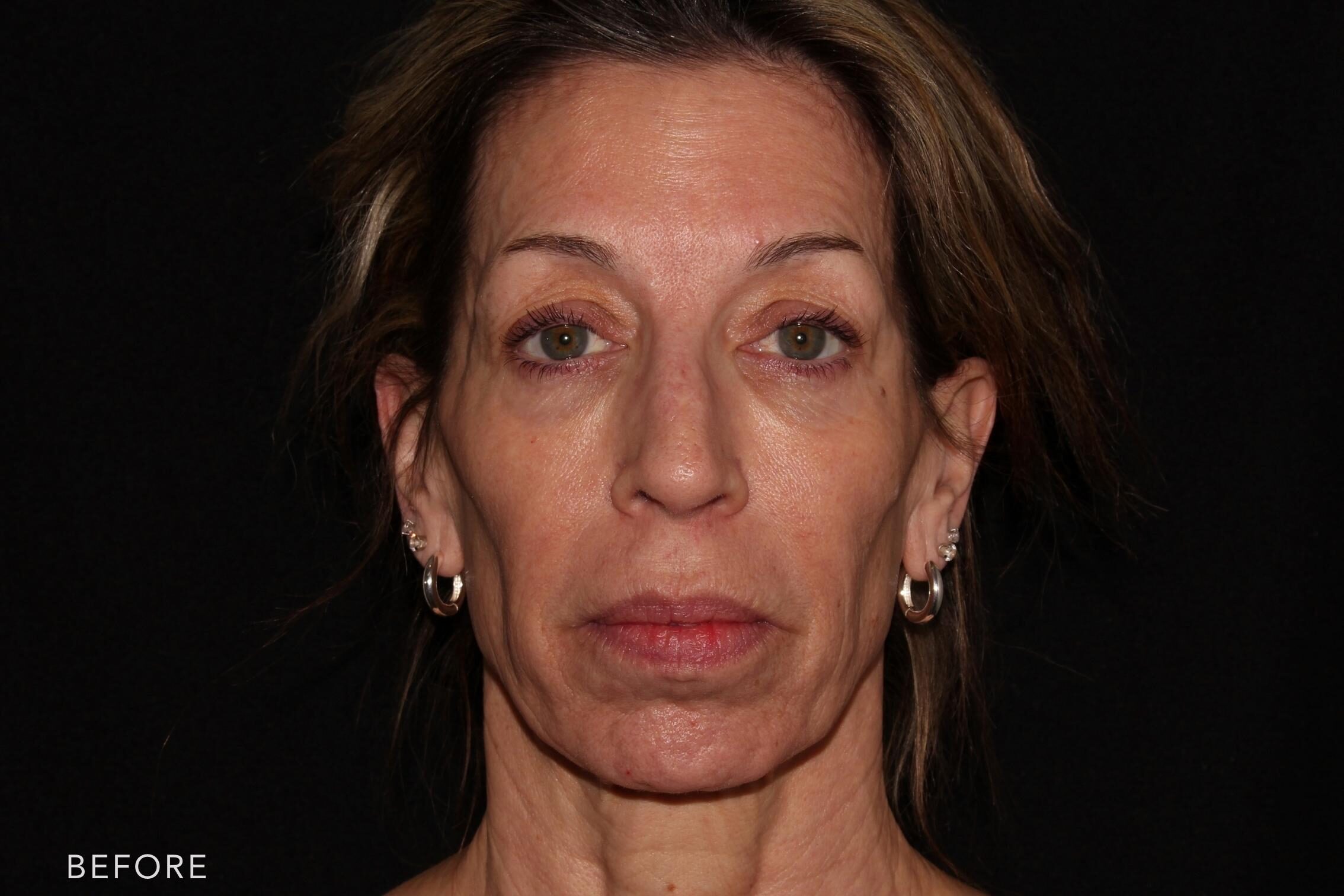 A photos of a woman's face before and after Botox procedure. Before photo shows an evident fine lines and wrinkles in her face while after photo shows an improved appearance of puffiness, wrinkles and dark shadows which makes her look younger. | Albany, Latham, Saratoga NY, MedSpa