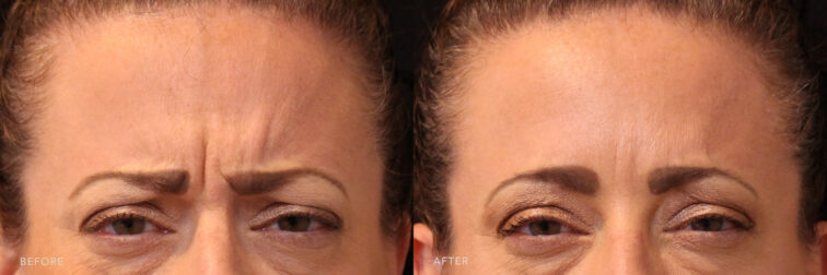 A photos of a woman's face before and after Botox procedure. Before photo shows fine lines and dullness appearance in her forehead while after photo shows smoother and more improved appearance in her forehead.| Albany, Latham, Saratoga NY, MedSpa