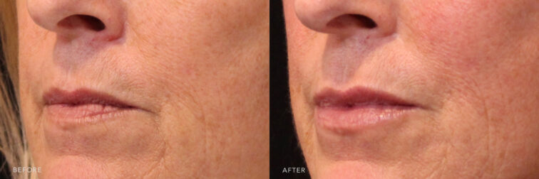 This is a side by side view photos of a woman's lower face before and after Lip Filler procedure. Before photo shows tired muscles leaving her lips to look thinner and evident wrinkles around her mouth while after photo shows more precise and defined lip shape with her reduced vertical wrinkles around her lips.| Albany, Latham, Saratoga NY, MedSpa