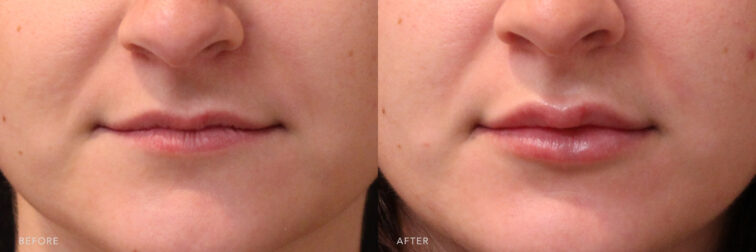 A photos of a woman's lower face before and after Lip Filler procedure. Before photo shows a tired muscles that her lips broke down leaving her lips looking thinner while after photo shows a fuller and smoother lips.| Albany, Latham, Saratoga NY, MedSpa