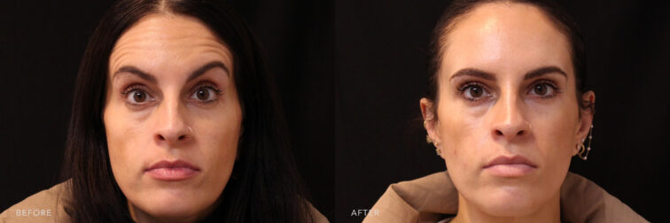 This is a photo of a woman's face with her horizontal creases in the forehead. | Albany, Latham, Saratoga NY, MedSpa