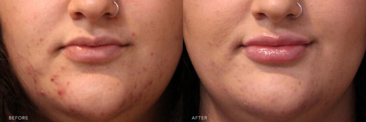 A photos of a woman's lower face before and after Lip Filler procedure. Before photo shows lost of volume of her lips that caused to have a shapeless lips while after photo shows more defined and voluptuous lips. | Albany, Latham, Saratoga NY, MedSpa