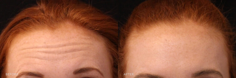 A photos of a woman's upper face before and after Botox procedure. Before photo shows a forehead wrinkles and fine lines while after photo shows a plumped up fine lines and wrinkles that gave an overall smoother complexion.| Albany, Latham, Saratoga NY, MedSpa