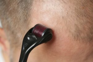 microneedling application on an adult’s head with brown, thinning hair