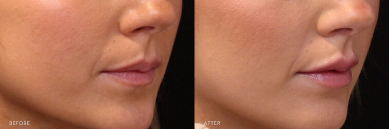 A side by side view photos of a woman's lower face before and after Lip Filler procedure. Before photo shows a less soft tissue leaving her top lip to become longer while after photo shows more volume to her lips that made it look more fuller and flushing lips.| Albany, Latham, Saratoga NY, MedSpa