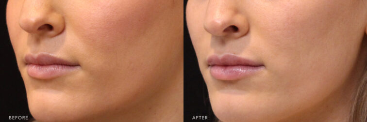This is a side by side view photos of a woman's lower face before and after Lip Filler procedure. Before photo shows a lack of lips moisture causing it to look dry while after photo shows a natural pink lips with her smoother and moisturized lips.| Albany, Latham, Saratoga NY, MedSpa