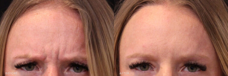 A photos of a woman's upper face before and after Botox procedure. Before photo shows a vissible horizontal lines across her forehead while after photo shows a youthful look with her springy and smooth feel skin.| Albany, Latham, Saratoga NY, MedSpa