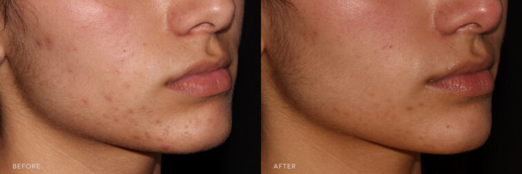 This is a side by side view photos of a woman's lower face before and after Microneeding procedure. Before photo shows a skin that lost its collagen causing to have the appearance of fine lines and wrinkles while after photo shows a smoother and firmer skin tone.| Albany, Latham, Saratoga NY, MedSpa