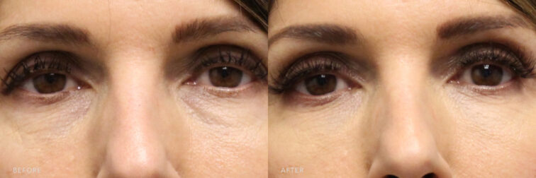 A photos of a woman's face before and after Under Eye Filler procedure. Before photo shows a noticeable dark circles under her eyes while after photo shows a brightened skin and restored volume under her eyes.| Albany, Latham, Saratoga NY, MedSpa