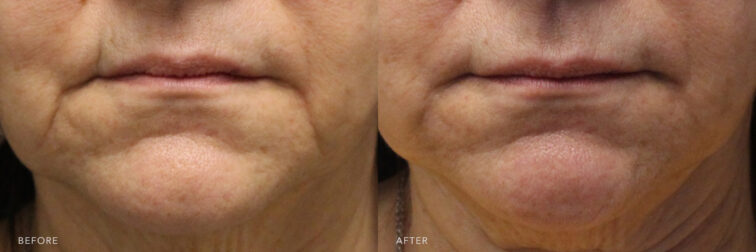 A photo of a woman's lower face before and after Mouth Filler procedure. Before photo shows a vertical lines between her mouth and chin that caused sagging in the lower half of her face while after photo shows a smoothed out lines around her mouth and chin creases. | Albany, Latham, Saratoga NY, MedSpa