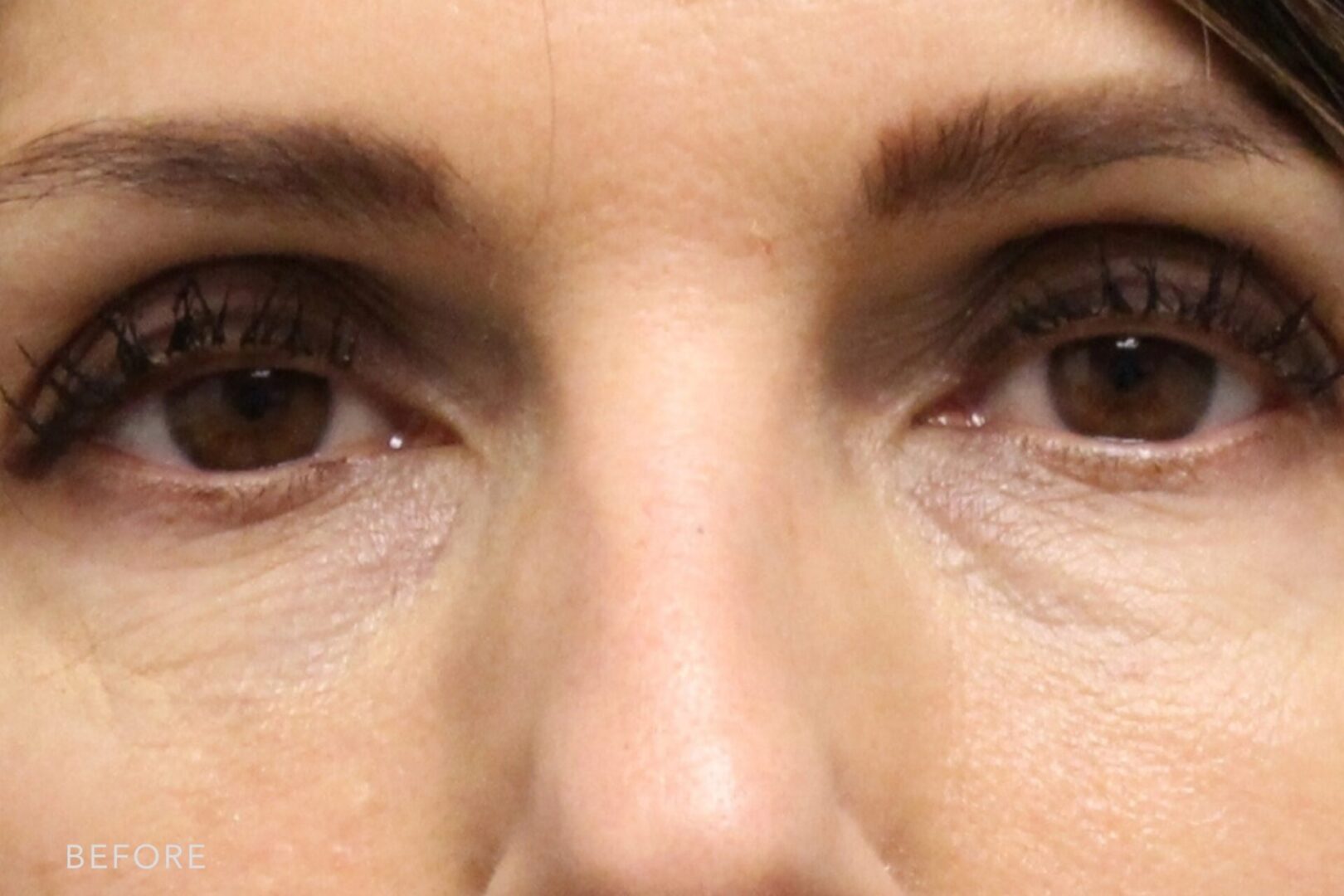 A photos of a woman's face before and after Under Eye Filler procedure. Before photo shows a noticeable dark circles under her eyes while after photo shows a brightened skin and restored volume under her eyes.| Albany, Latham, Saratoga NY, MedSpa