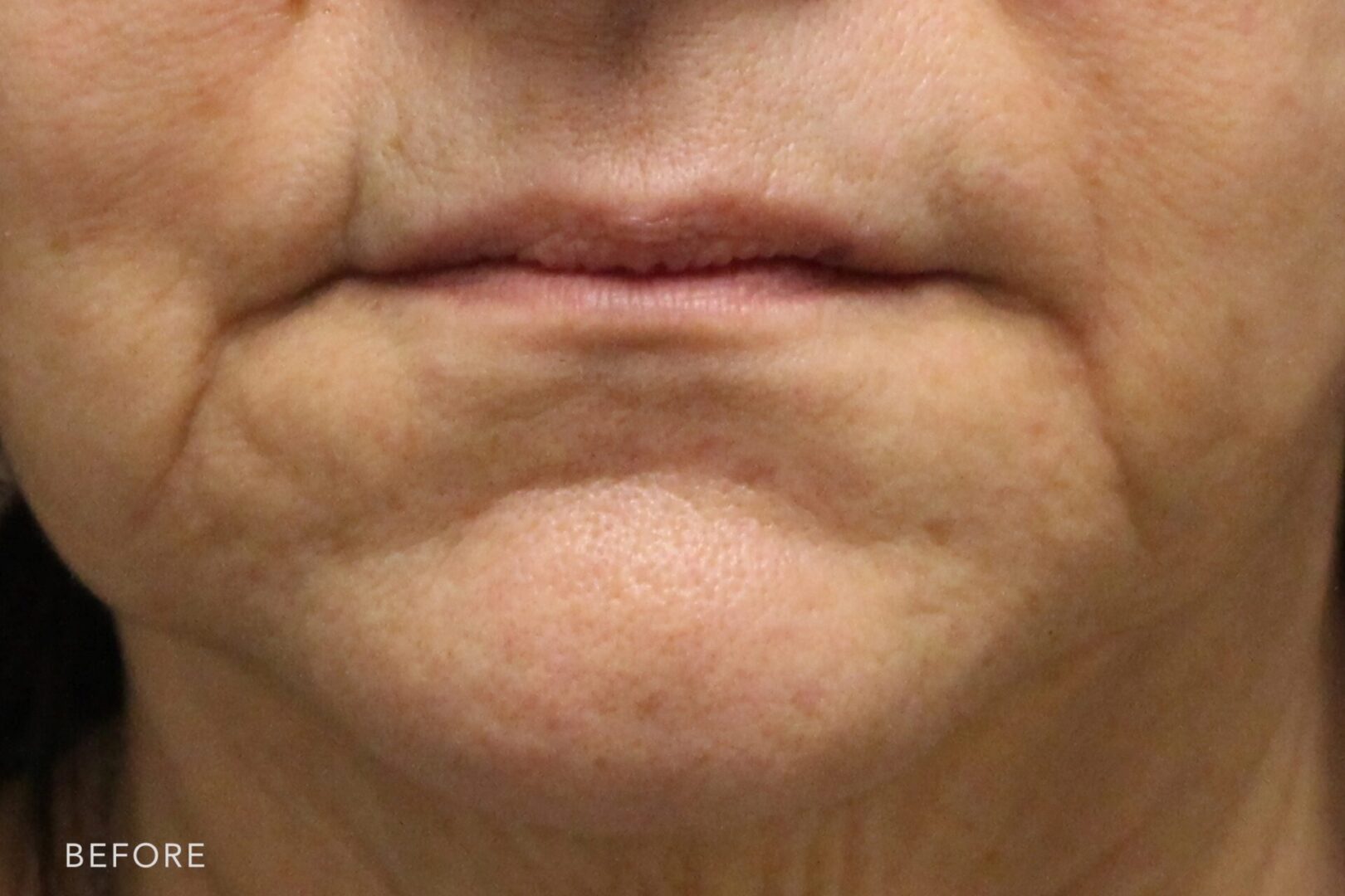 A photo of a woman's lower face before and after Mouth Filler procedure. Before photo shows a vertical lines between her mouth and chin that caused sagging in the lower half of her face while after photo shows a smoothed out lines around her mouth and chin creases. | Albany, Latham, Saratoga NY, MedSpa