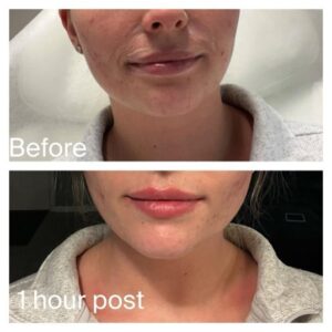 Before and after of patient receiving Botox and lip filler treatments