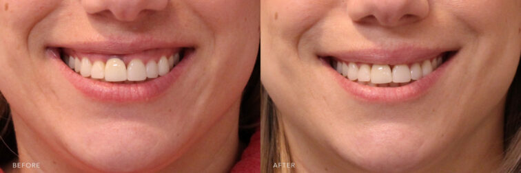 A photos of a woman's lower face befrore and after Lip Flip procedure. Before photo shows a top lip that disappears when she smiles and when her face is relaxed, they look disproportionately tiny while after photo shows a more enhanced appearance of her top lip with her fuller and poutier lips.| Albany, Latham, Saratoga NY, MedSpa