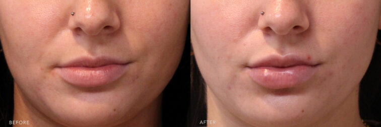 A photo of a woman's lower face before and after the Lip Fuller procedure. Before photo shows lips that appear less pronounced and has less defined borders, while the after photo shows well-defined vermilion bordered lips, resulting in a naturally fuller appearance of her upper and lower lip. | Albany, Latham, Saratoga NY, MedSpa