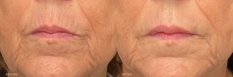A photo of a woman's lower face before and after the Chemical Peel procedure. Before photo shows folds on both sides of her face that extends from the base of her nose, curving downward and outward towards the corners of her mouth, creating a frame around the mouth area. While the after photo shows smoother and a softer appearance with fewer lines around the mouth, making them less noticeable and less prominent. | Albany, Latham, Saratoga NY, MedSpa