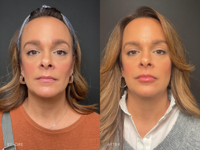 A photo of a woman's face before and after Lip Filler procedure. Before photo shows thinned lips that lack prominent curves and contours, making her lips appear small and flatter. While the after photo shows more prominent fullness of both the upper and lower lips, making them appear more substantial and well-rounded. | Albany, Latham, Saratoga NY, MedSpa