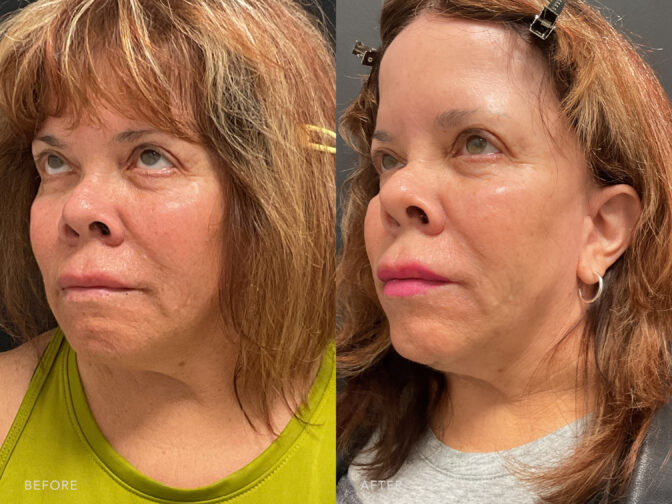 A side-by-side view of a woman's face before and after Toxin/Filler Treatment. Before photo shows vissble lines, creases, or folds around her skin's surface, caused by natural aging where the skin's lost its collagen and elastin, leading to a decrease in her skin elasticity and the formation of her facial wrinkles. While the after photo shows fewer and less pronounced lines, wrinkles, uniform texture with minimal variations in color, tone and texture, resulting to a more vibrant and well-nourished skin. | Albany, Latham, Saratoga NY, MedSpa