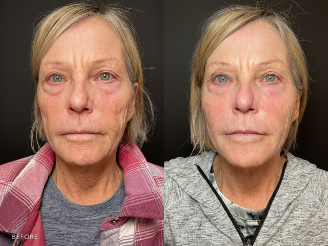 A photo of a woman's face before and after Botox and Filler Treatment. Before photo displays vissible lines around her face, leading to a rougher skin texture, caused by natural aging. While the after photo shows fewer vissible lines and a decreased number of lines or wrinkles compared to areas with more pronounced lines, leading to a more relaxed and refreshed look. | Albany, Latham, Saratoga NY, MedSpa