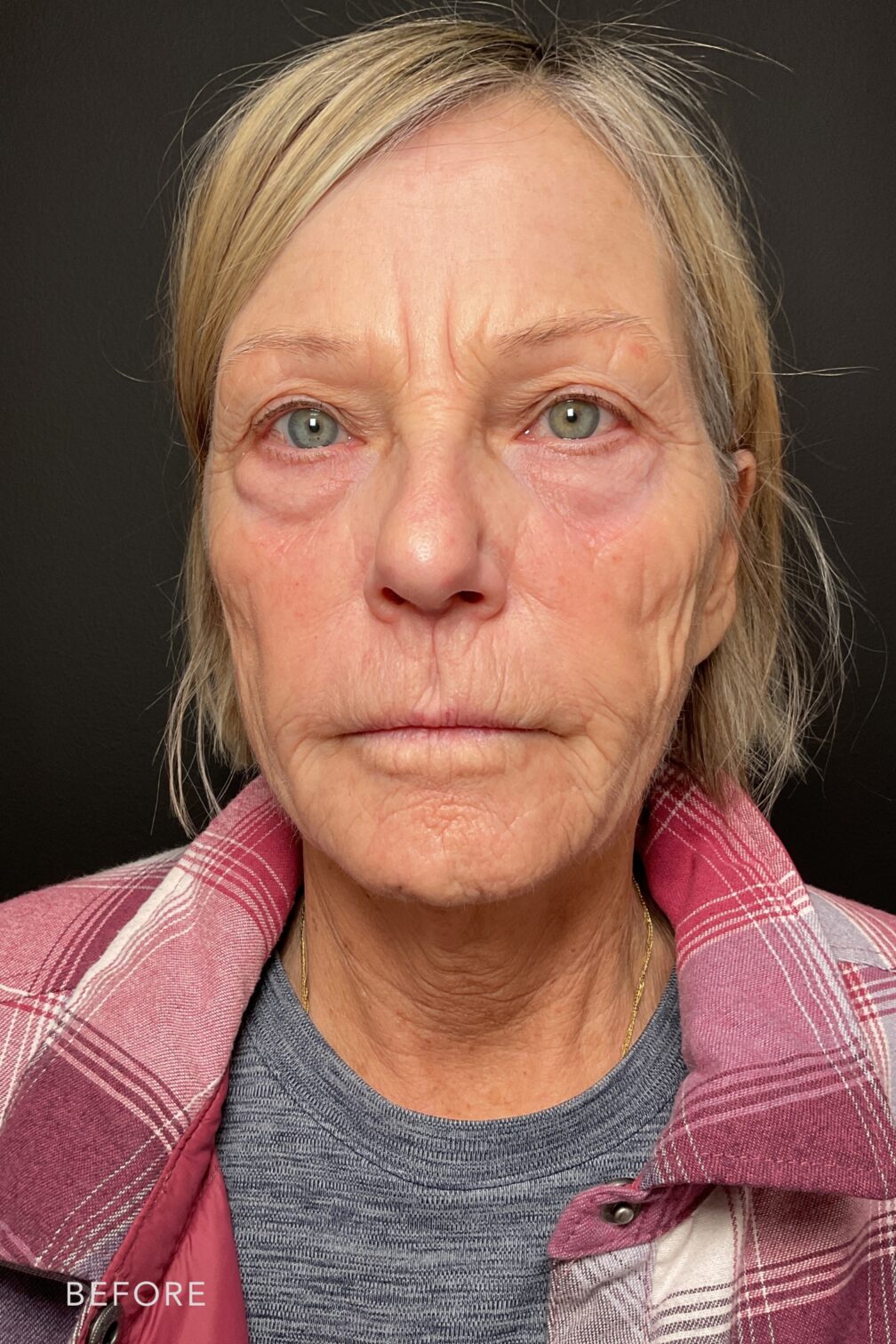 A photo of a woman's face before and after Botox and Filler Treatment. Before photo displays vissible lines around her face, leading to a rougher skin texture, caused by natural aging. While the after photo shows fewer vissible lines and a decreased number of lines or wrinkles compared to areas with more pronounced lines, leading to a more relaxed and refreshed look. | Albany, Latham, Saratoga NY, MedSpa