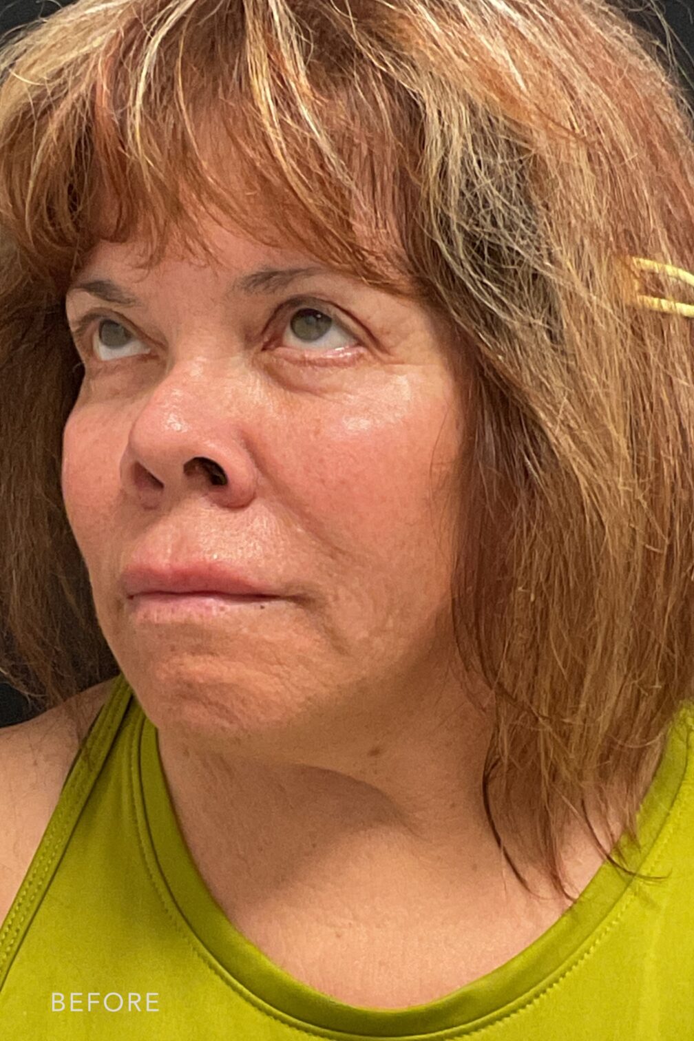 A side-by-side view of a woman's face before and after Toxin/Filler Treatment. Before photo shows vissble lines, creases, or folds around her skin's surface, caused by natural aging where the skin's lost its collagen and elastin, leading to a decrease in her skin elasticity and the formation of her facial wrinkles. While the after photo shows fewer and less pronounced lines, wrinkles, uniform texture with minimal variations in color, tone and texture, resulting to a more vibrant and well-nourished skin. | Albany, Latham, Saratoga NY, MedSpa