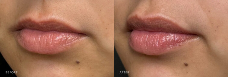 A photo of woman's lower face before and after Lip Flip procedure. Before photo shows a narrow or thin upper lip compared to the lower lip, with less volume or prominence. While the after photo shows a proportionate width of her upper and lower lips, contributing to a balanced and aesthetically pleasing lip profile. | Albany, Latham, Saratoga NY, MedSpa