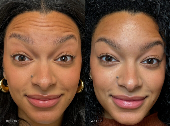 A photos of a woman's upper face before and after the Botox procedure. Before photo shows a superficial fine lines or furrows between her eyebrows, contributing to a rough or uneven compared to surrounding smooth skin. While the after photo shows flat and unblemished, with no visible lines, creases, or wrinkles disrupting its surface, contributing to a fresh, rejuvenated, and aesthetically pleasing facial appearance. | Albany, Latham, Saratoga NY, MedSpa