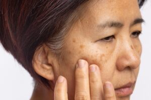 A middle-aged woman examining sunspots on her face