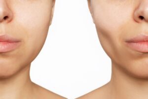 Close up of the sides of two women's faces, the one on the right with sunken cheeks