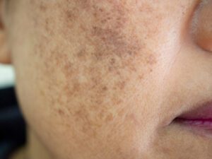 Close up of the uneven skin tone on a woman's cheek