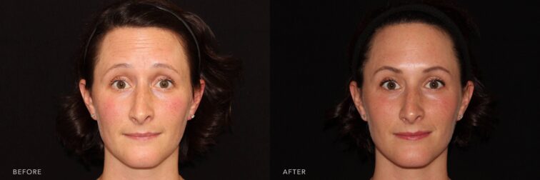 A photo of a woman's face before and after the Botox procedure. The before photo shows forehead wrinkles highlighting every thoughtful expression and animated conversation. The after photo shows an effortlessly smooth skin, untouched by the traces of past expressions. | Albany, Latham, Saratoga NY, Plastic Surgery