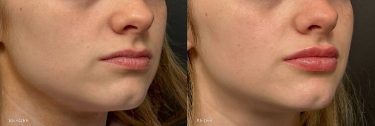 This is a side-by-side view of a woman's lower face before and after the 0.85 mL of RHA3 Lip Filler procedure. The before photo shows lips with natural asymmetries, one side being fuller or more lifted than the other, and her lips appearing drier or less supple. The after photo shows asymmetries between her upper and lower lips or the left and right sides, giving them a poutier, more three-dimensional look when viewed from the side. | Albany, Latham, Saratoga NY, Plastic Surgery