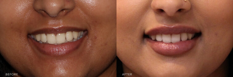 This is a photo of a woman's lower face before and after Lip Filler procedure. Before photo shows a vertical lip lines that formed above her upper lip while after photo shows an evenly shaped lips with her relaxed and curled outward lips.| Albany, Latham, Saratoga NY, MedSpa